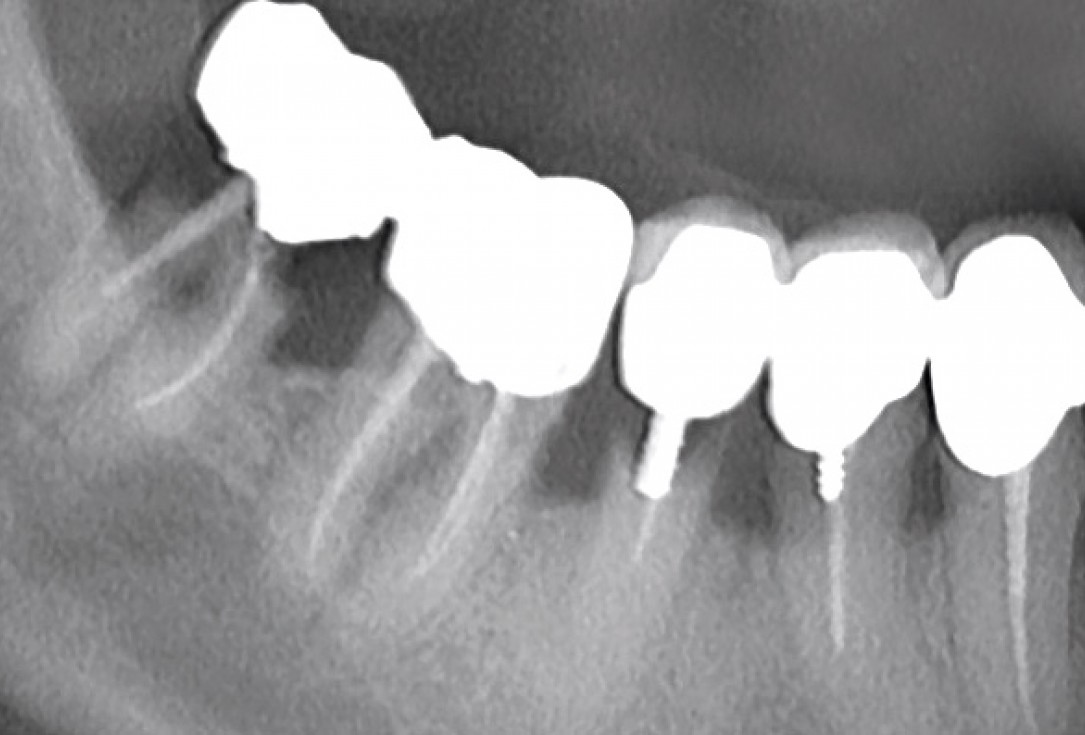 Multiple socket preservation in the mandibular with collacone® max – Dr. D. Jelušić