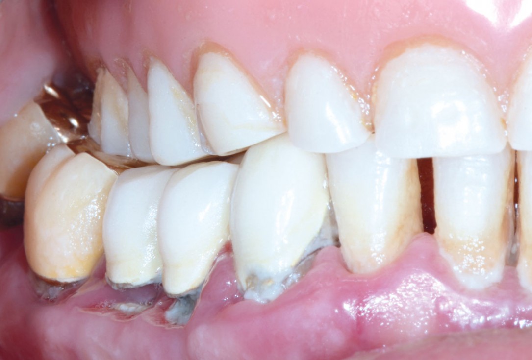 Multiple socket preservation in the mandibular with collacone® max – Dr. D. Jelušić