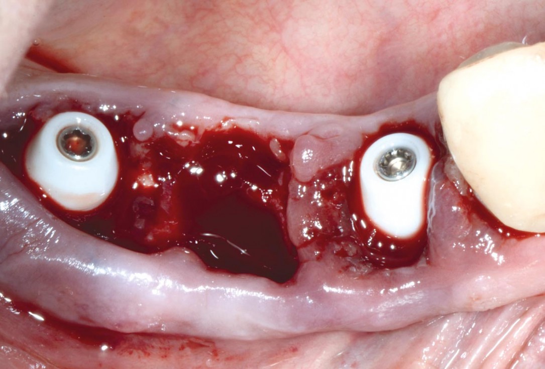 Multiple socket preservation in the mandibular with collacone® max – Dr. D. Jelušić