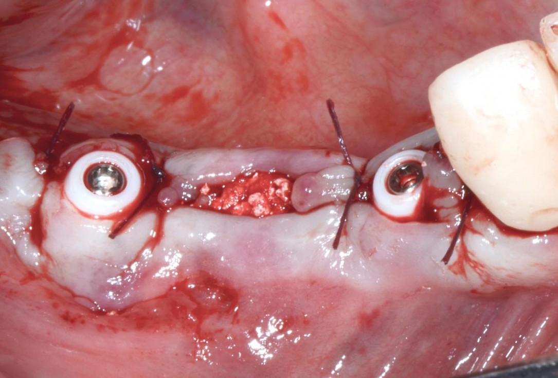 Multiple socket preservation in the mandibular with collacone® max – Dr. D. Jelušić