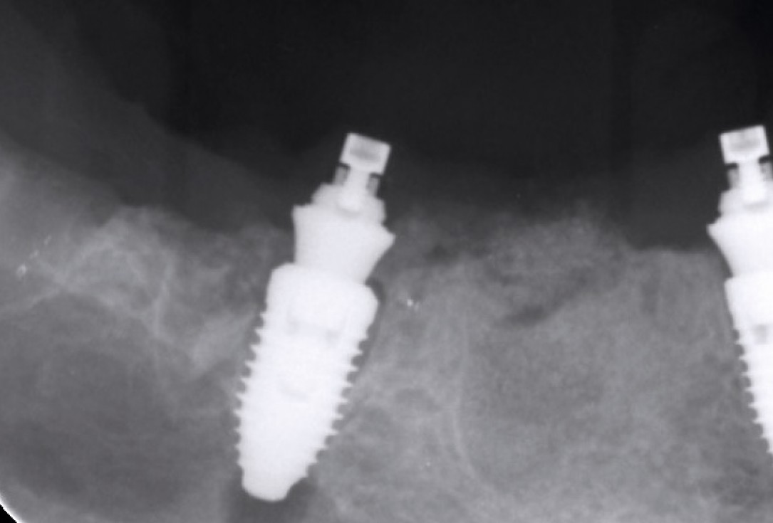 Multiple socket preservation in the mandibular with collacone® max – Dr. D. Jelušić
