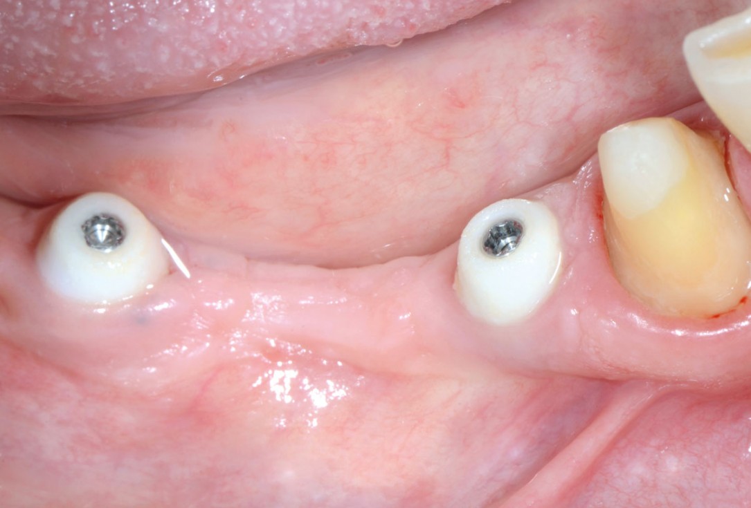 Multiple socket preservation in the mandibular with collacone® max – Dr. D. Jelušić