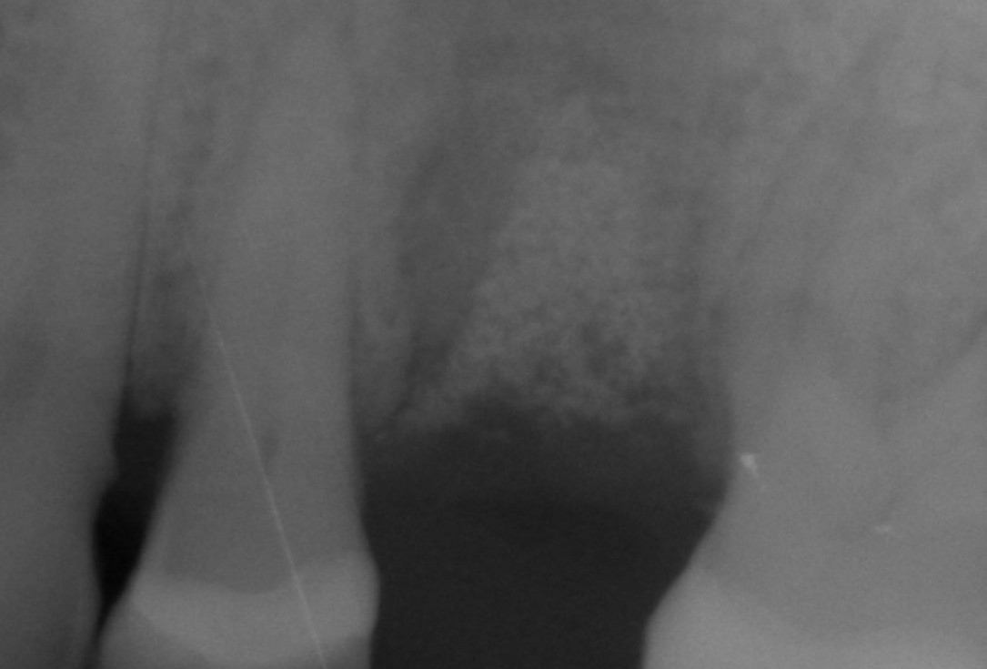 GBR at implant site - Dr. A. Nisio