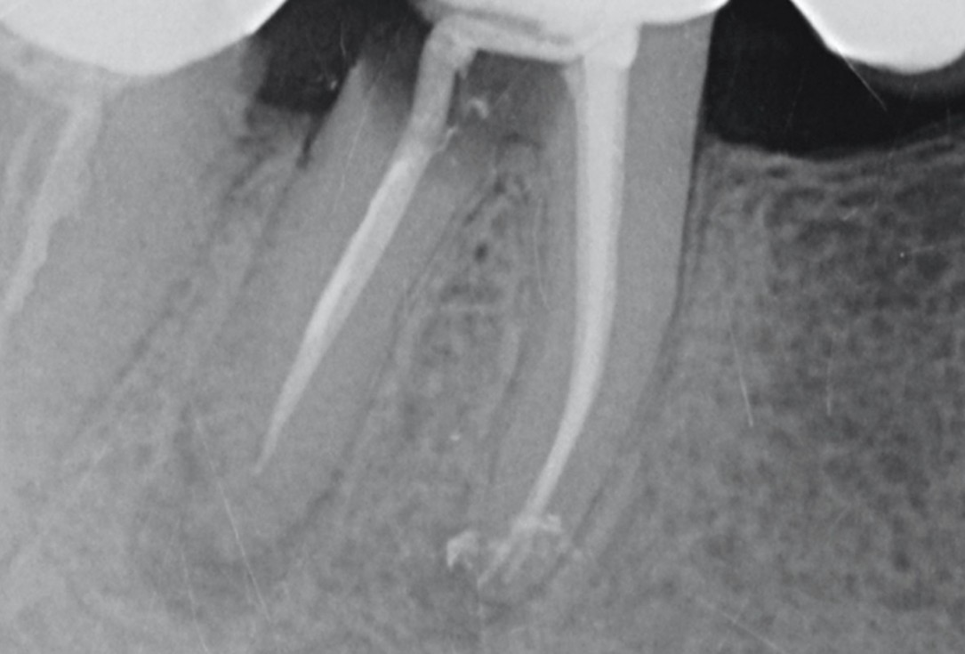 Immediate implantation with maxresorb® - Dr. M. Frosecchi