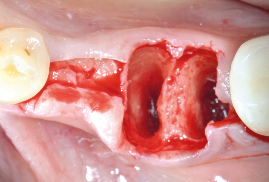 Immediate implantation with maxresorb® - Dr. M. Frosecchi