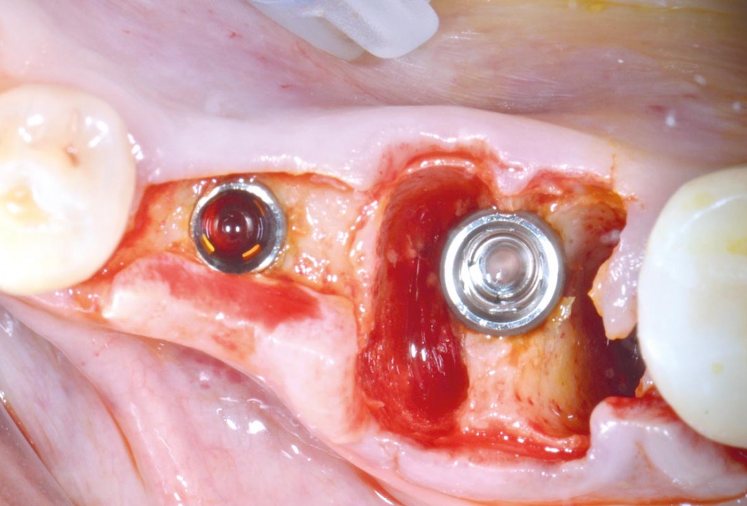 Immediate implantation with maxresorb® - Dr. M. Frosecchi