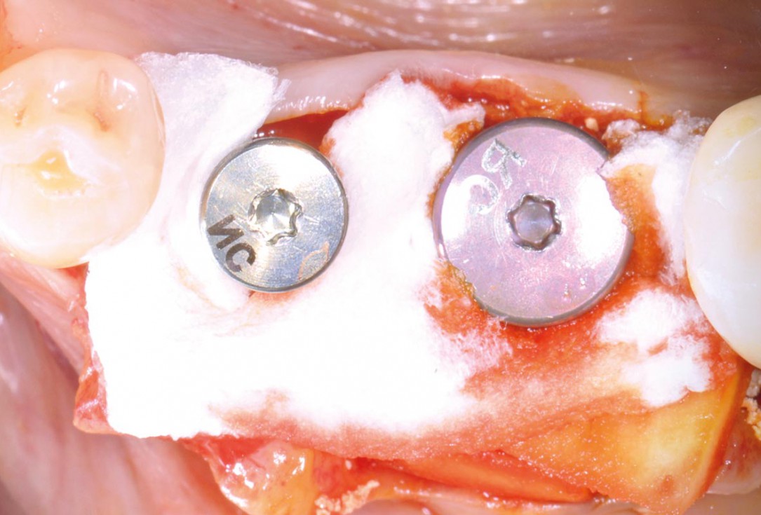 Immediate implantation with maxresorb® - Dr. M. Frosecchi