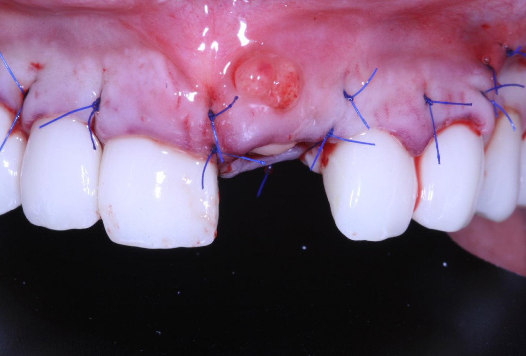 Treatment of an endo-perio-lesion and soft tissue augmentation with mucoderm® - Dr. A. Eslava Vanegas