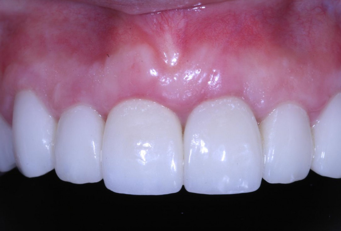 Treatment of an endo-perio-lesion and soft tissue augmentation with mucoderm® - Dr. A. Eslava Vanegas