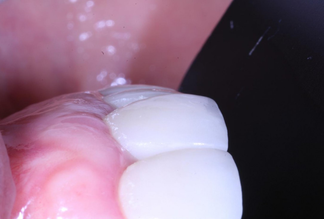 Treatment of an endo-perio-lesion and soft tissue augmentation with mucoderm® - Dr. A. Eslava Vanegas