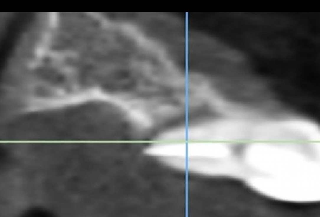 Treatment of an endo-perio-lesion and soft tissue augmentation with mucoderm® - Dr. A. Eslava Vanegas