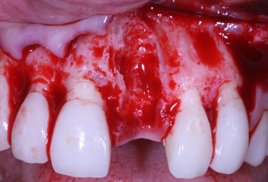 Treatment of an endo-perio-lesion and soft tissue augmentation with mucoderm® - Dr. A. Eslava Vanegas