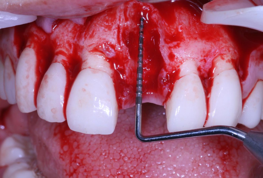 Treatment of an endo-perio-lesion and soft tissue augmentation with mucoderm® - Dr. A. Eslava Vanegas