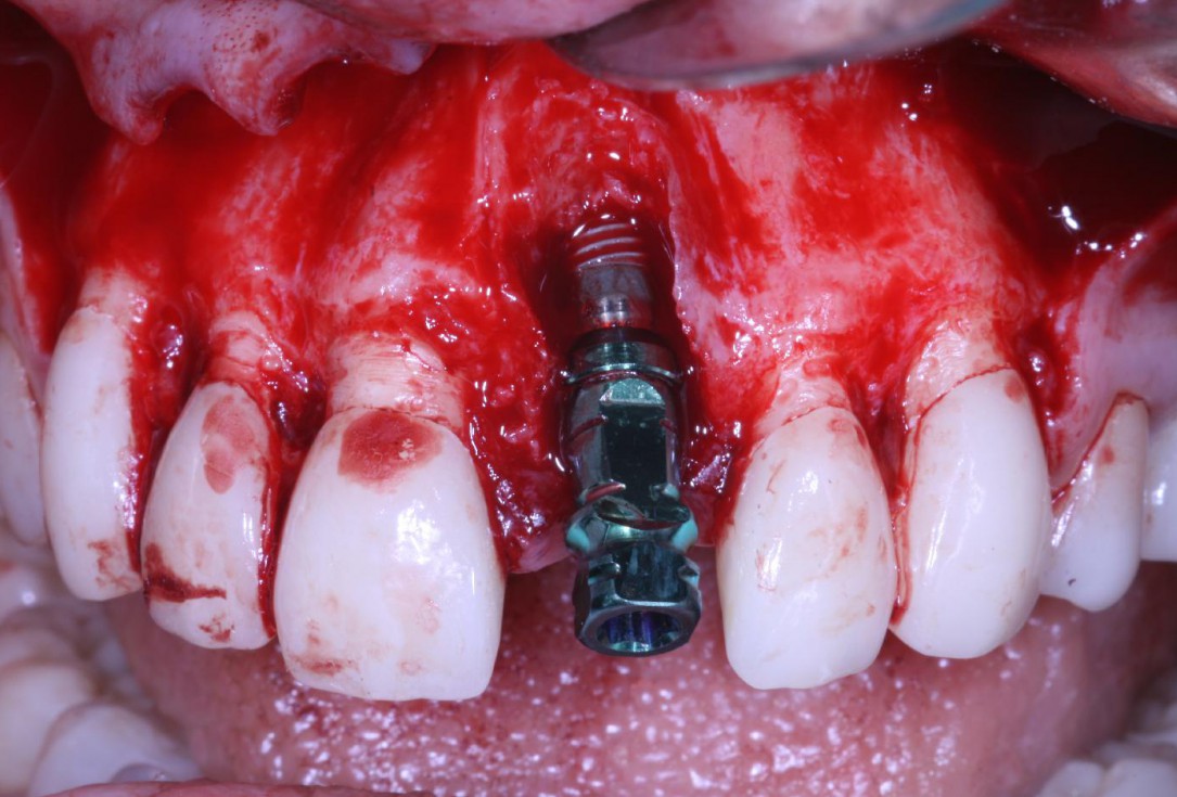 Treatment of an endo-perio-lesion and soft tissue augmentation with mucoderm® - Dr. A. Eslava Vanegas