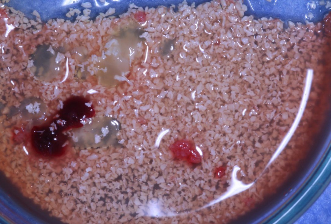 Treatment of an endo-perio-lesion and soft tissue augmentation with mucoderm® - Dr. A. Eslava Vanegas