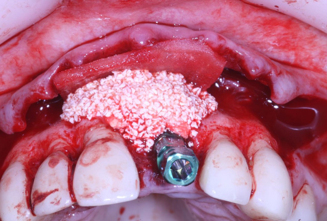 Treatment of an endo-perio-lesion and soft tissue augmentation with mucoderm® - Dr. A. Eslava Vanegas