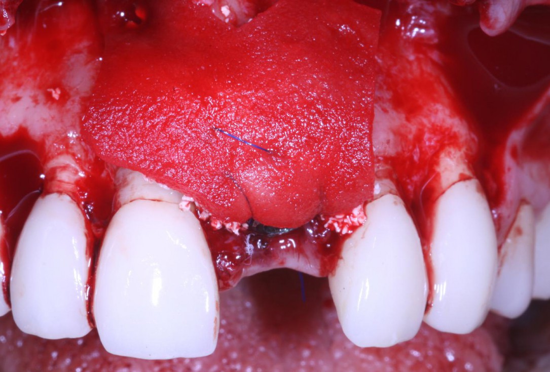 Treatment of an endo-perio-lesion and soft tissue augmentation with mucoderm® - Dr. A. Eslava Vanegas