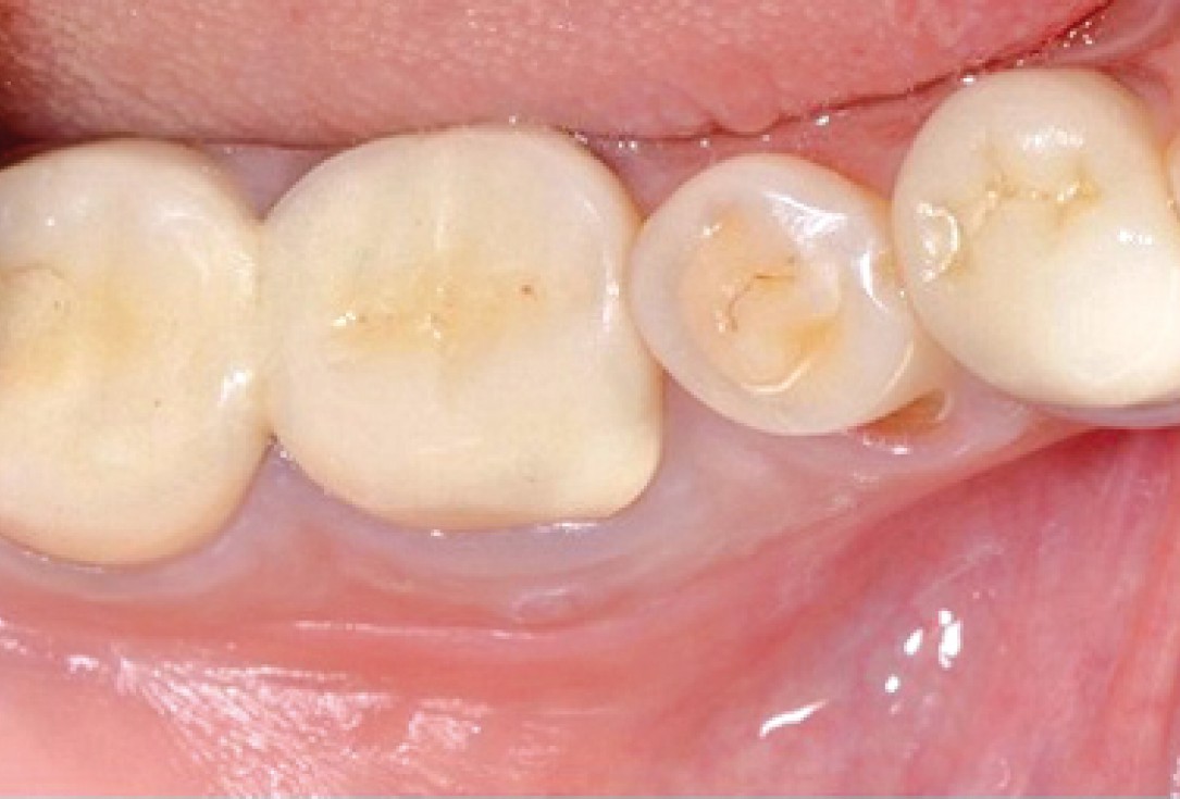 Socket seal surgery with mucoderm® - Dr. M. Frosecchi