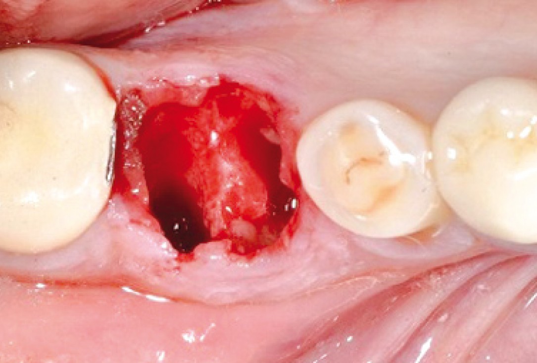 Socket seal surgery with mucoderm® - Dr. M. Frosecchi