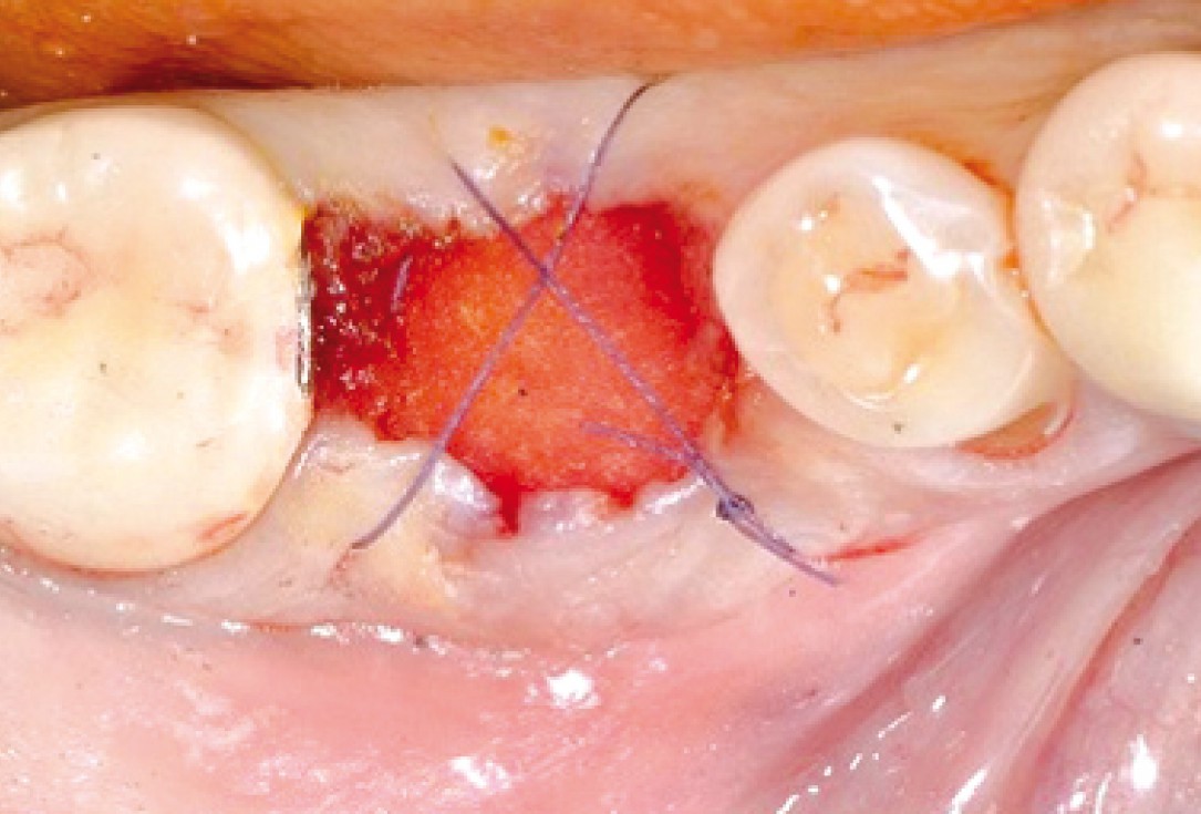 Socket seal surgery with mucoderm® - Dr. M. Frosecchi