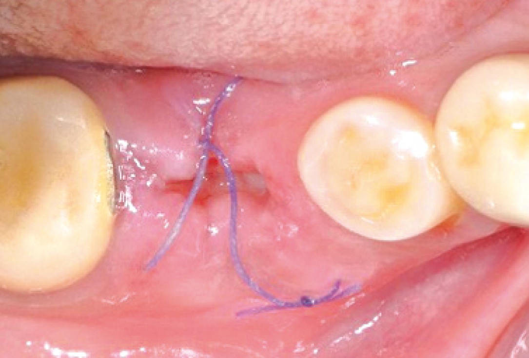 Socket seal surgery with mucoderm® - Dr. M. Frosecchi