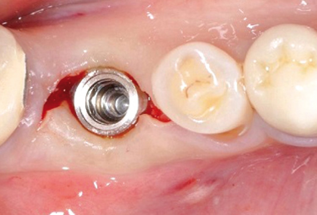 Socket seal surgery with mucoderm® - Dr. M. Frosecchi