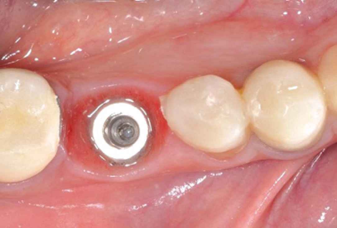 Socket seal surgery with mucoderm® - Dr. M. Frosecchi