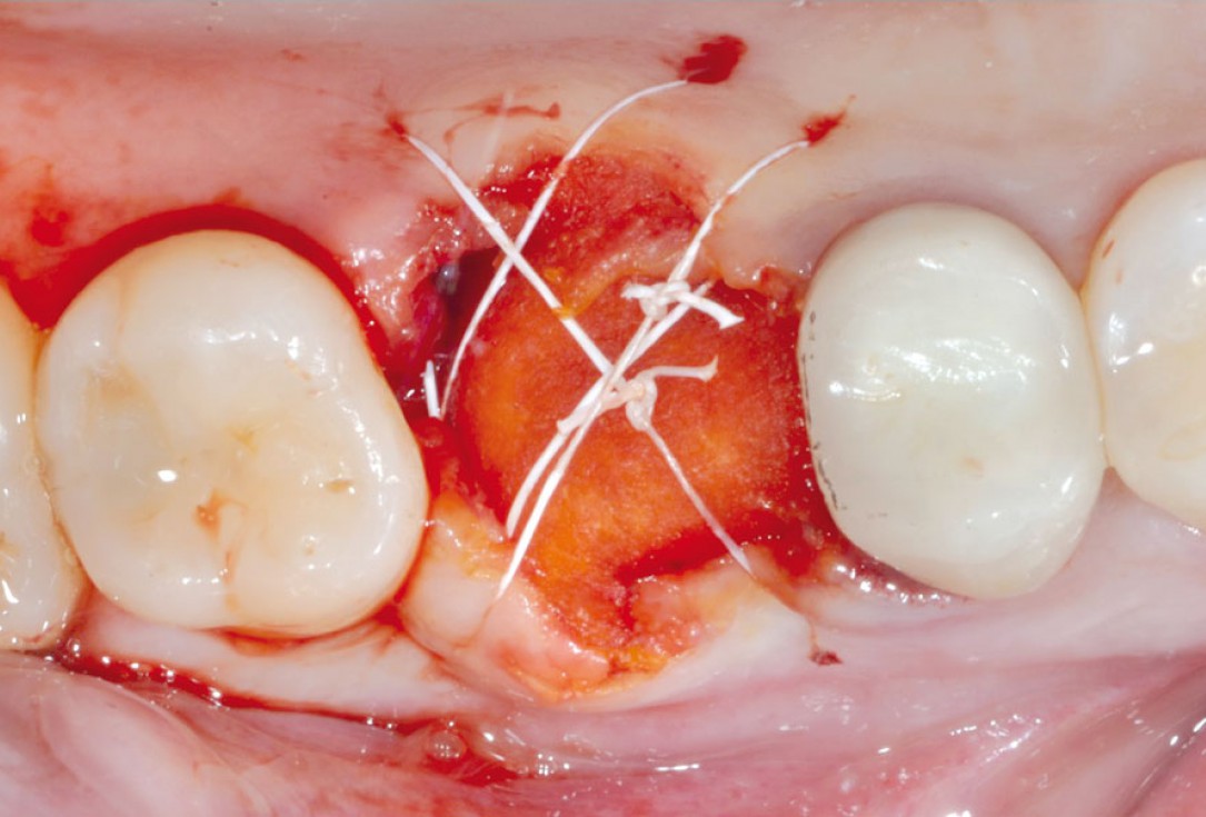 Socket sealing with mucoderm® - Dr. M. Frosecchi