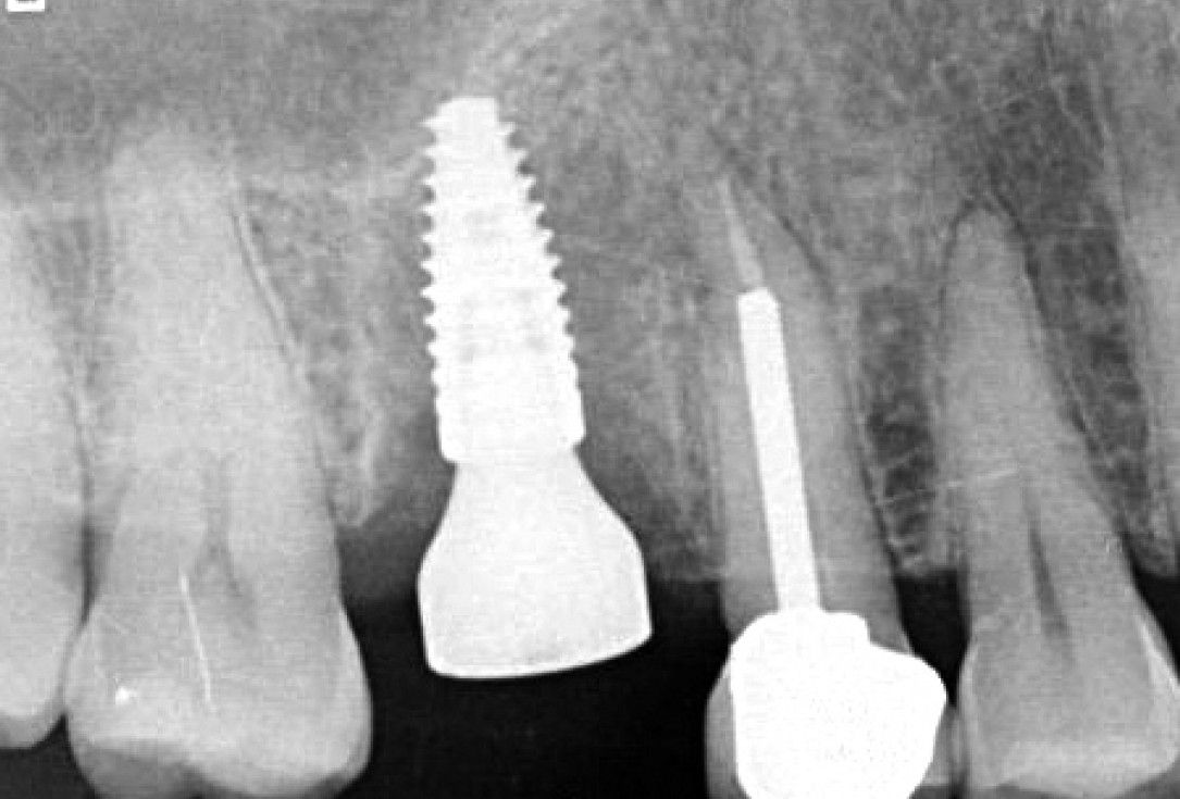 Socket sealing with mucoderm® - Dr. M. Frosecchi