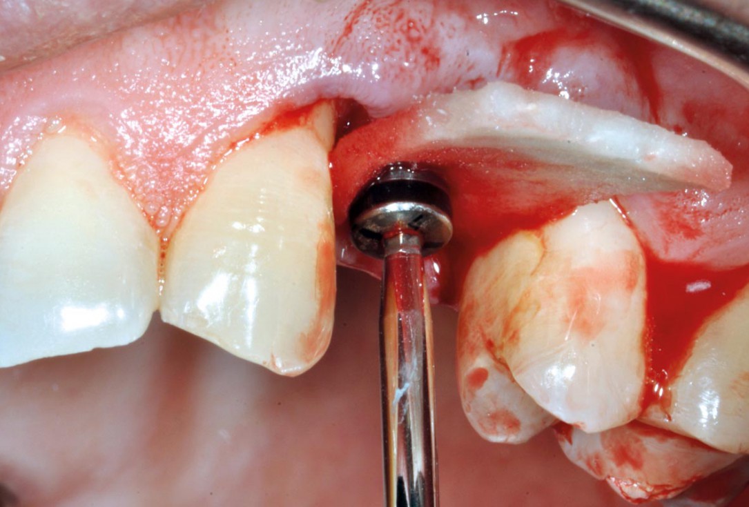 Treatment of a soft tissue deficiency with mucoderm® - Dr. F. Rojas-Vizcaya