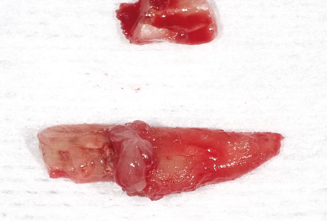 Socket seal with mucoderm® punch