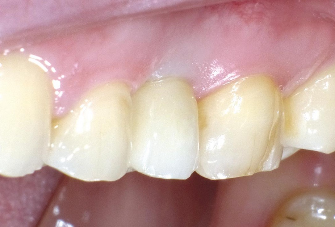 Socket seal with mucoderm® punch