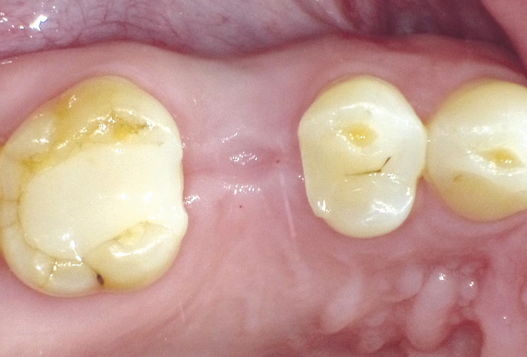 Socket seal with mucoderm® punch