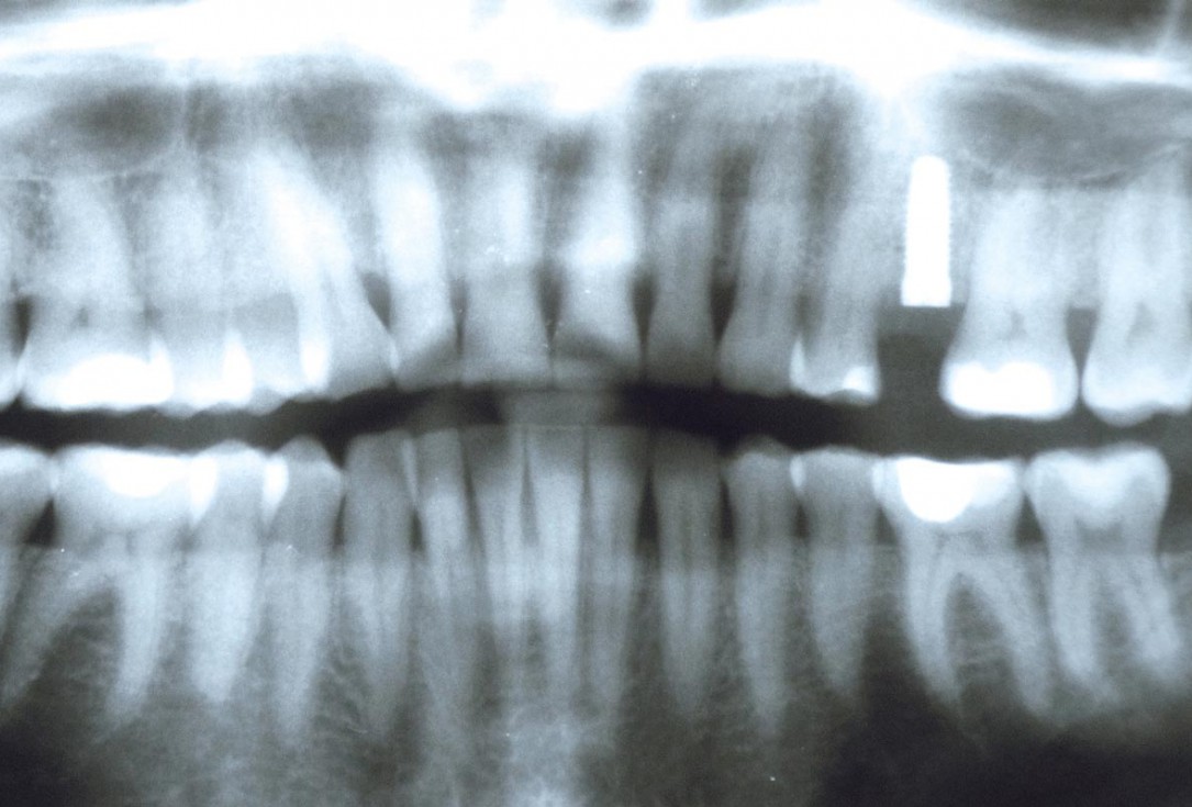 Socket seal with mucoderm® punch