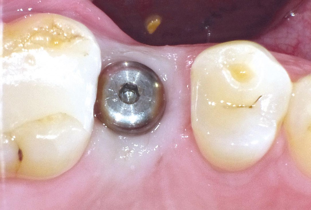 Socket seal with mucoderm® punch