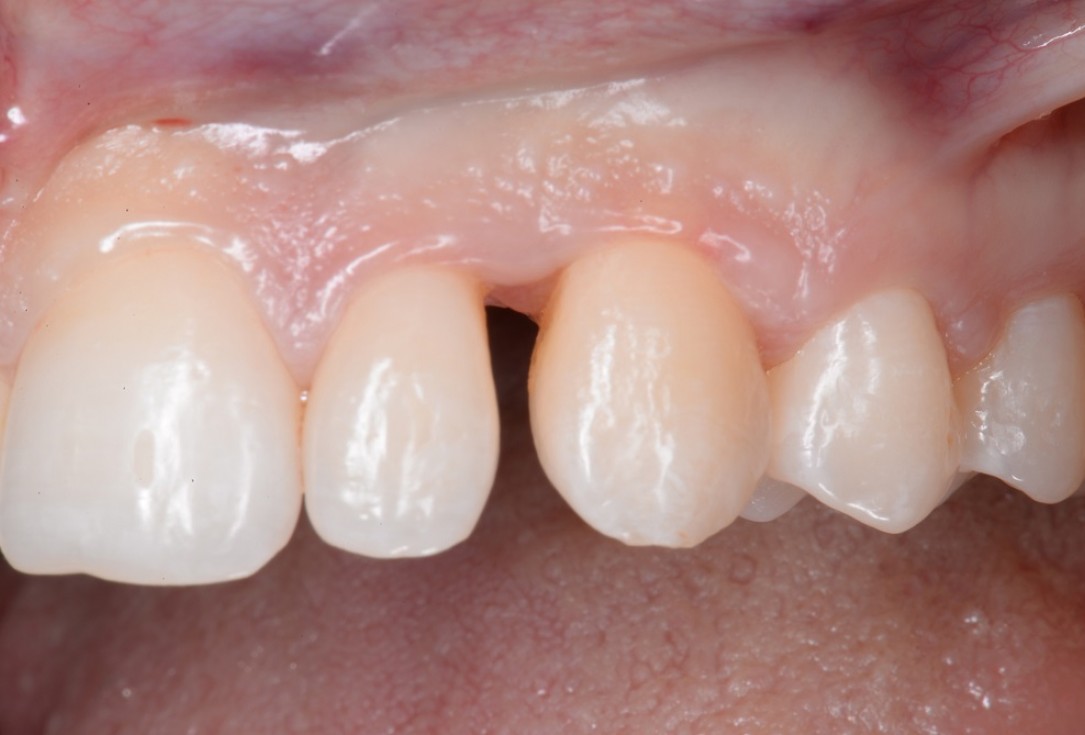 Non-contained intrabony defect treated by the MPPF in conjunction with cerabone® and Straumann® Emdogain® - Tunkel