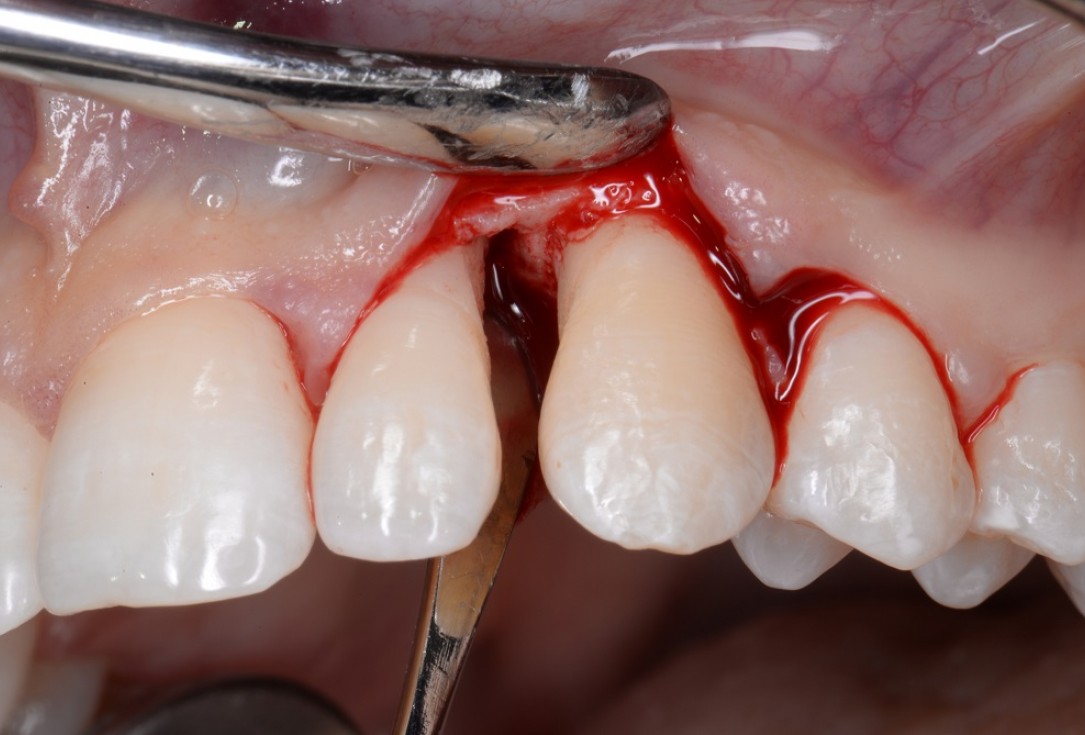 Non-contained intrabony defect treated by the MPPF in conjunction with cerabone® and Straumann® Emdogain® - Tunkel