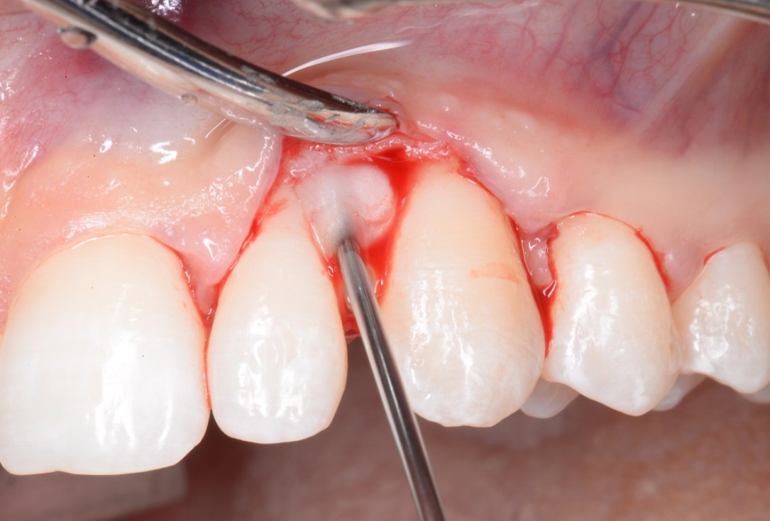 Non-contained intrabony defect treated by the MPPF in conjunction with cerabone® and Straumann® Emdogain® - Tunkel