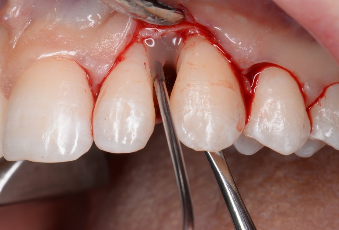 Non-contained intrabony defect treated by the MPPF in conjunction with cerabone® and Straumann® Emdogain® - Tunkel