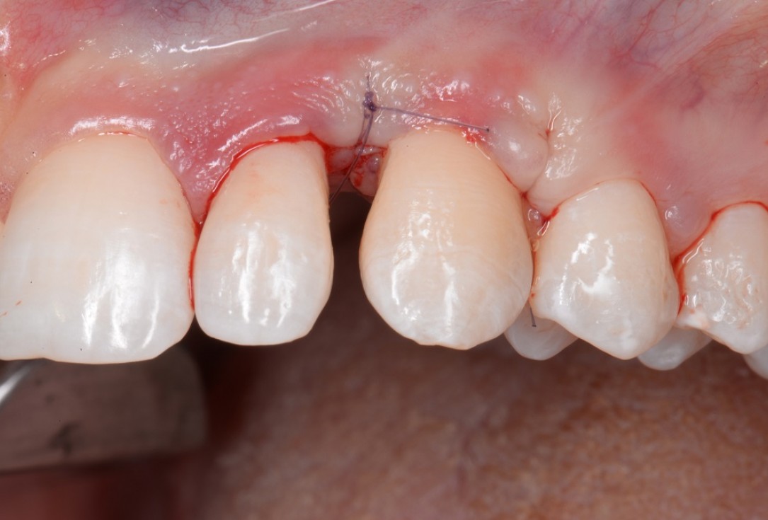 Non-contained intrabony defect treated by the MPPF in conjunction with cerabone® and Straumann® Emdogain® - Tunkel