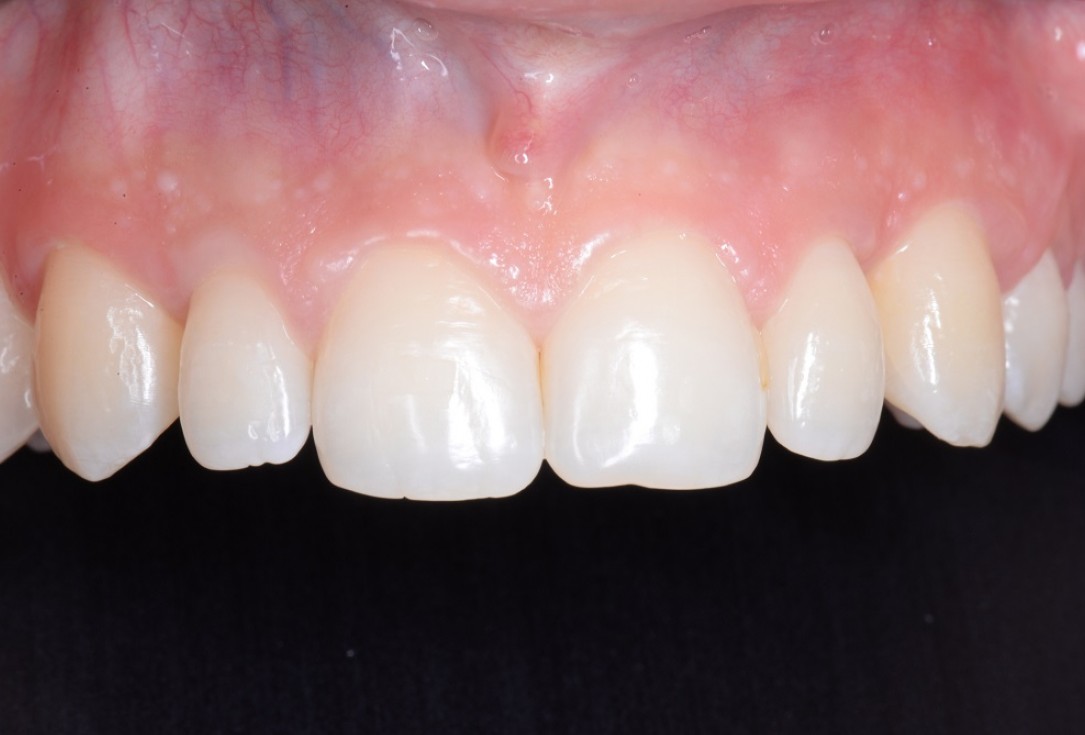 Non-contained intrabony defect treated by the MPPF in conjunction with cerabone® and Straumann® Emdogain® - Tunkel