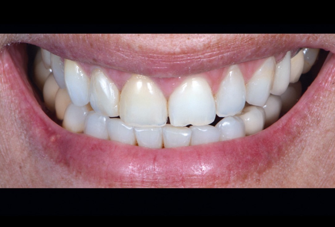 cerabone® and mucoderm® for immediacy in esthetic zone -Dr. M Motta