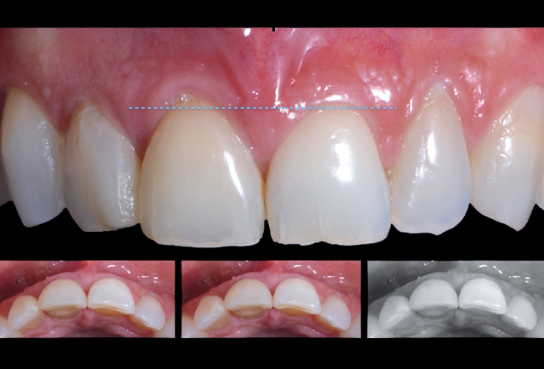 cerabone® and mucoderm® for immediacy in esthetic zone -Dr. M Motta