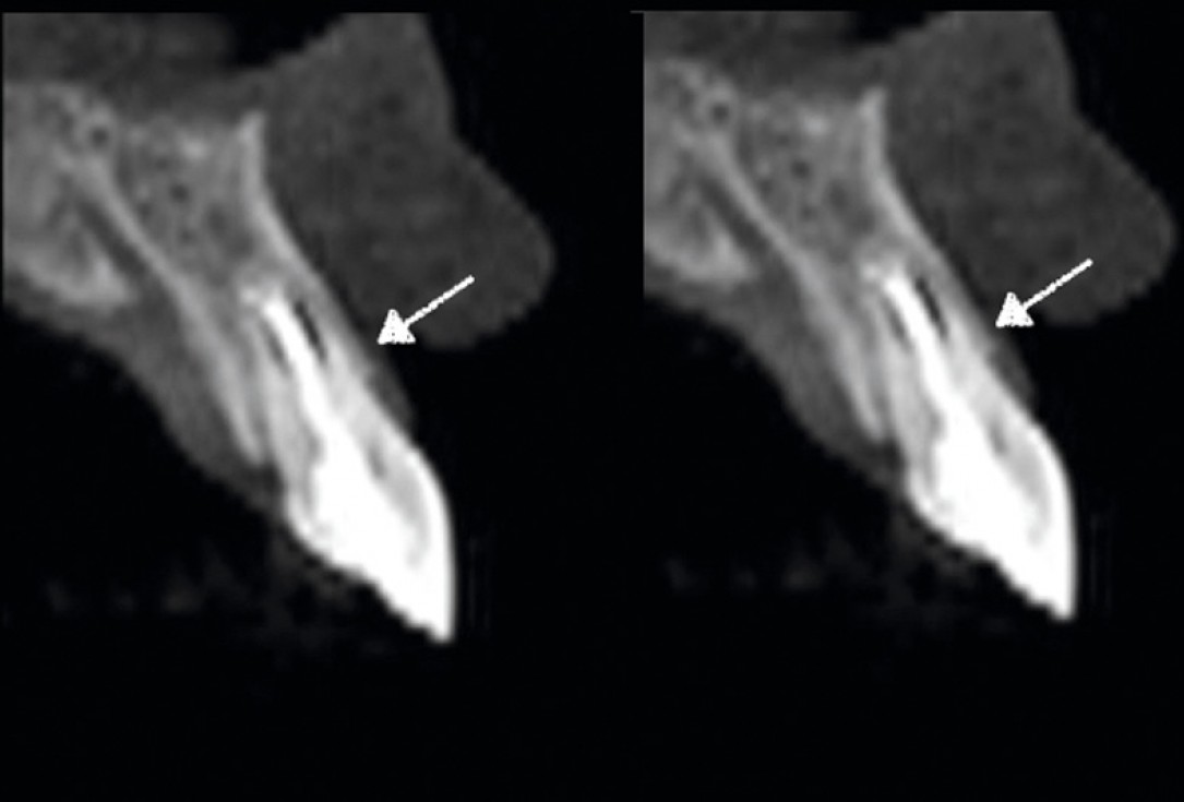 cerabone® and mucoderm® for immediacy in esthetic zone -Dr. M Motta
