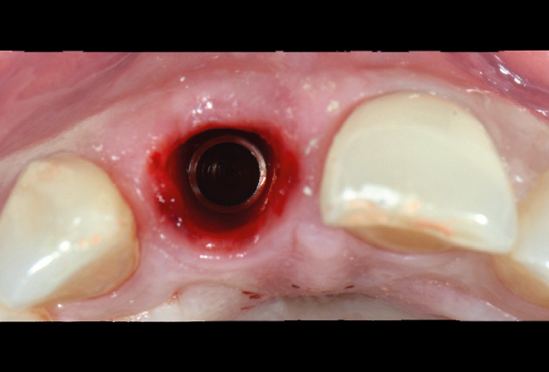 cerabone® and mucoderm® for immediacy in esthetic zone -Dr. M Motta