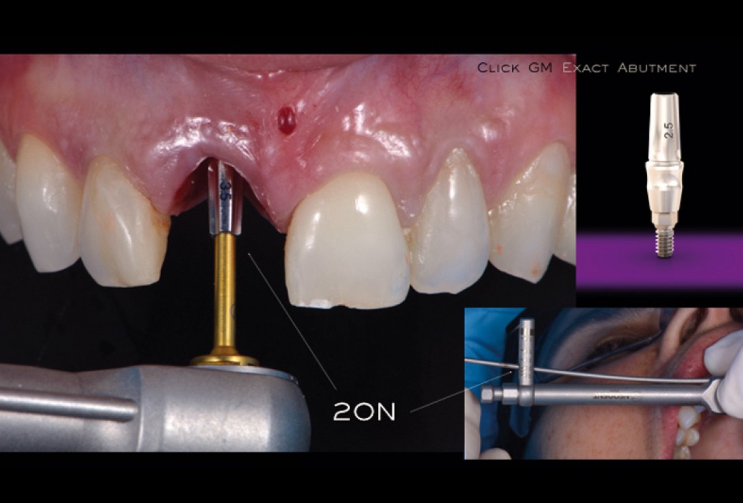 cerabone® and mucoderm® for immediacy in esthetic zone -Dr. M Motta