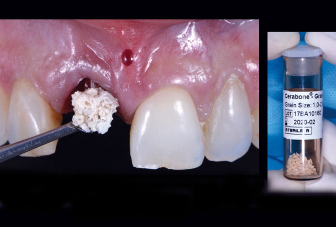 cerabone® and mucoderm® for immediacy in esthetic zone -Dr. M Motta