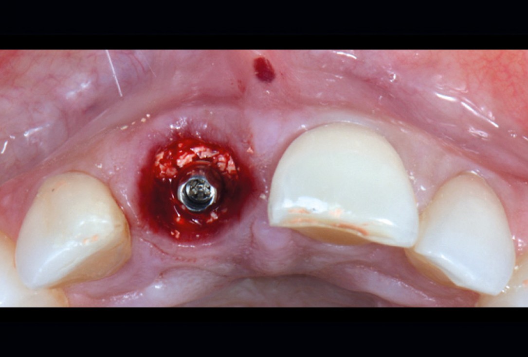 cerabone® and mucoderm® for immediacy in esthetic zone -Dr. M Motta