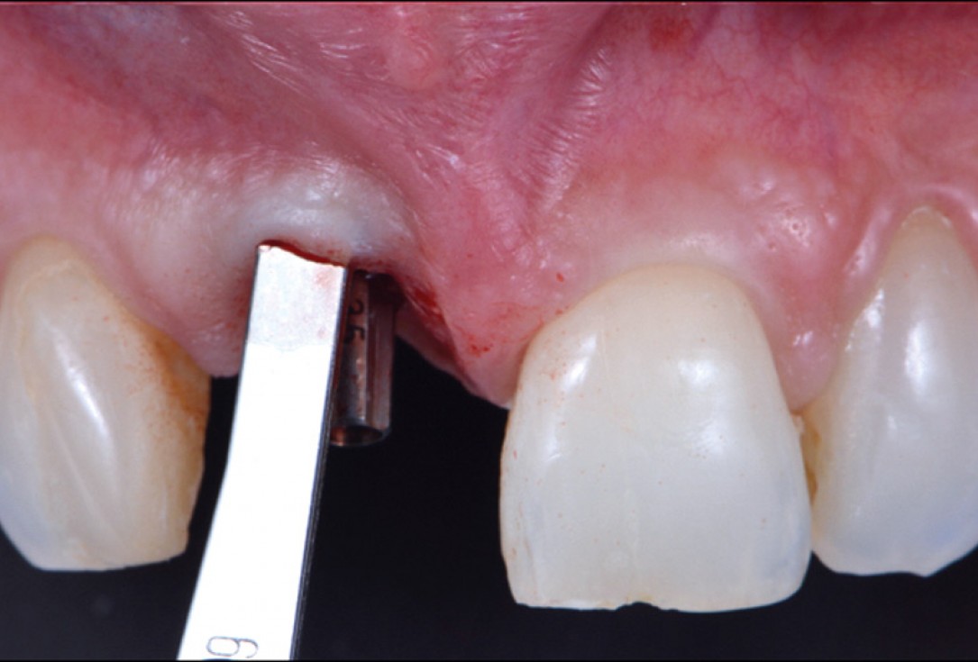 cerabone® and mucoderm® for immediacy in esthetic zone -Dr. M Motta