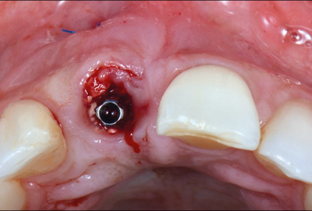 cerabone® and mucoderm® for immediacy in esthetic zone -Dr. M Motta